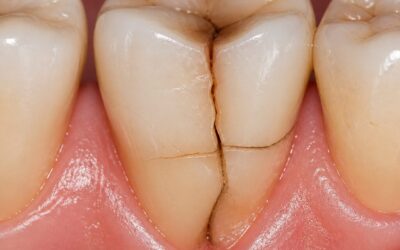 Cracked Tooth Syndrome: The Dental Diagnosis That Is Often Missed