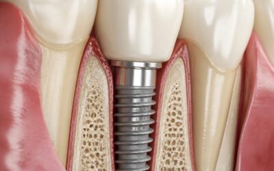 Dental Implants: What You Should Know Before the Consultation
