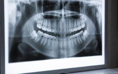 Dental X-Rays: How Often Do You Actually Need Them