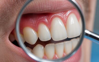 Gum Disease: Early Warning Signs Most People Miss