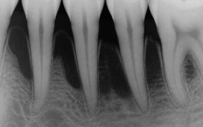 Periodontal Disease Explained: How It Develops and What Actually Stops It