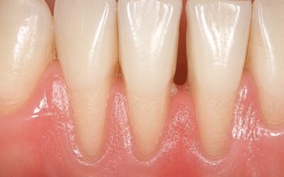 Receding Gums: What Causes It and What Actually Slows It Down