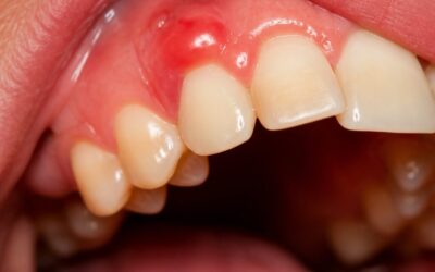 Swollen Gum Around One Tooth: Causes and When to Act