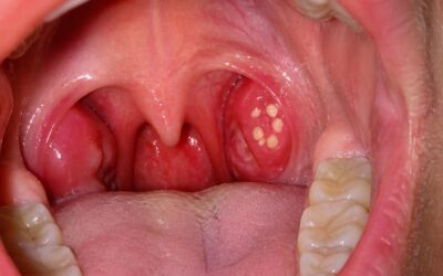 Tonsil Stones and Bad Breath: The Connection Most People Miss